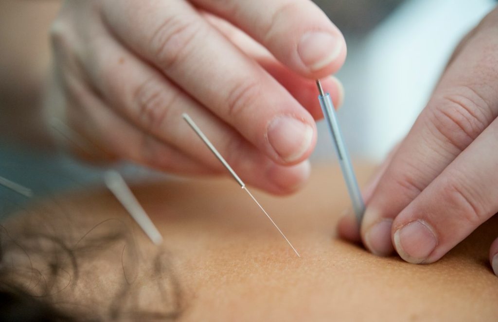 acupuncture-needles-inserted-into-skin-qgcdtm9ra5s