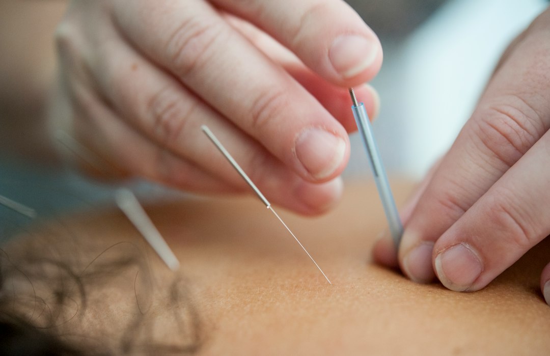 acupuncture-needles-inserted-into-skin-qgcdtm9ra5s